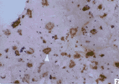 阿爾茨海默病性痴呆