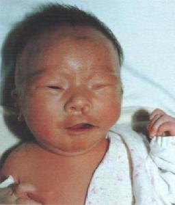 巨細胞病毒感染