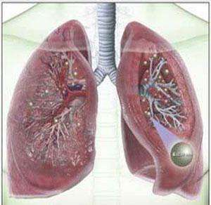 普通問質性肺炎