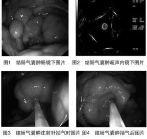 結腸氣囊腫 結腸氣囊腫