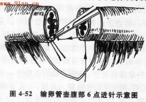 輸卵管再通吻合術 輸卵管再通吻合術
