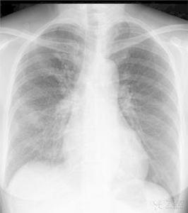 特魯索症 特魯索症