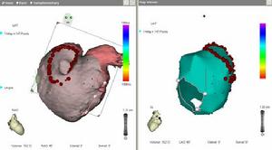 三維消融技術 三維消融技術
