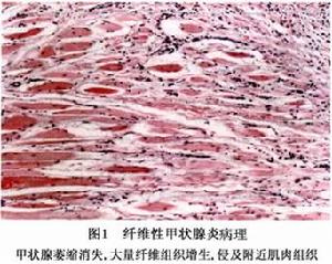 慢性纖維性甲狀腺炎