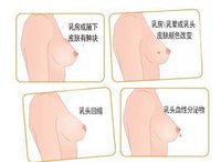 乳房脂肪瘤