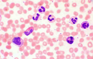 慢性髓系白血病 慢性髓系白血病