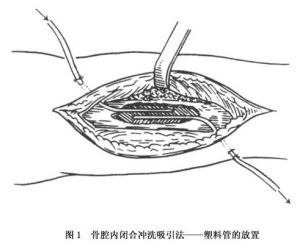 （圖）慢性血源性骨髓炎