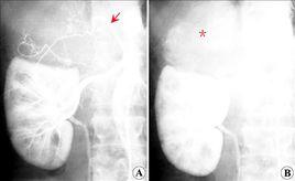 腎上腺動脈造影 腎上腺動脈造影