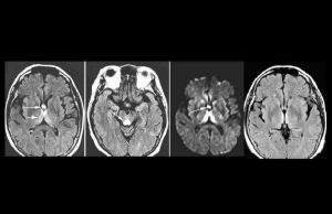 新生兒膽紅素 新生兒膽紅素