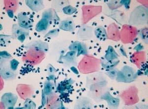 反應性細胞改變 反應性細胞改變