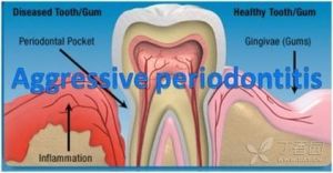 侵襲性牙周炎 侵襲性牙周炎