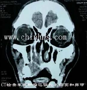 上頜竇惡性腫瘤