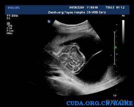 體蒂異常 體蒂異常