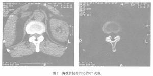 黃韌帶骨化症 黃韌帶骨化症