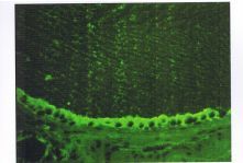 地方性甲狀腺腫