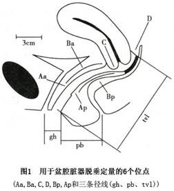 絕經期盆腔臟器脫垂