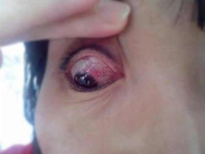 角膜大小不等的透明水泡 角膜大小不等的透明水泡