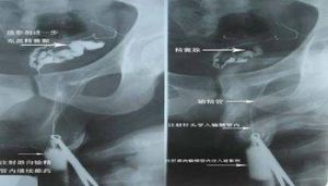 精囊腫瘤 精囊腫瘤