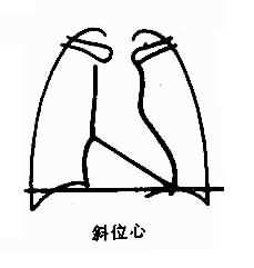 斜位心 斜位心