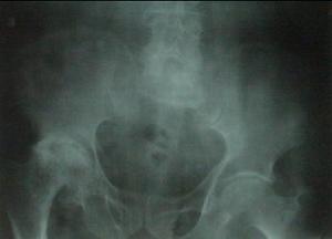 股骨頭壞死早期