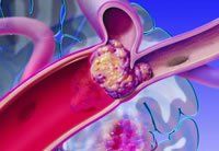 脂肪栓塞 脂肪栓塞