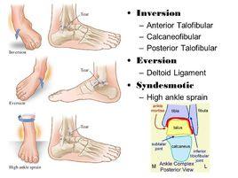 韌帶扭傷 韌帶扭傷