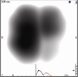 類肺炎性胸腔積液