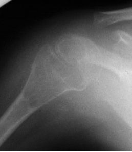 骨質疏鬆 骨質疏鬆