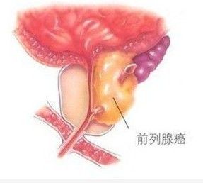 前列腺癌