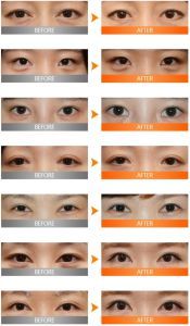 內、外眼角修復前後照片