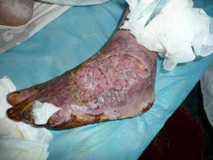 糖尿病爛腳症狀