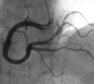 造影手術 造影手術