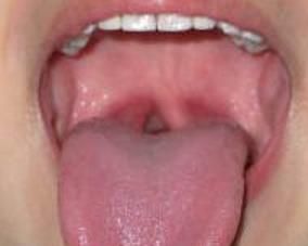 慢性舌扁桃體炎