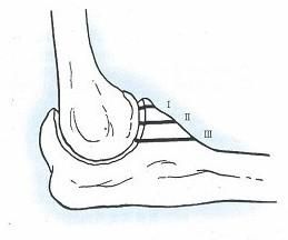 尺骨冠狀突骨折 尺骨冠狀突骨折