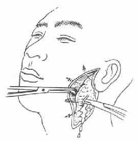 急性化膿性腮腺炎