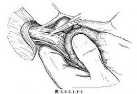 經胸食管肌層切開術 經胸食管肌層切開術