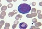 III型異型淋巴細胞