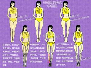 O型腿對身材的危害示意圖