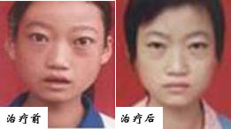 甲狀腺素毒性突眼