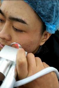 雷射除皺 雷射除皺