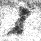 包涵體肌炎 包涵體肌炎