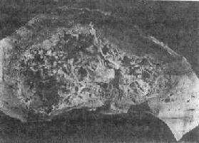 阿米巴性肝膿腫