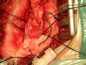 馬尾腫瘤 馬尾腫瘤