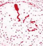 （圖）非01霍亂弧菌腸炎