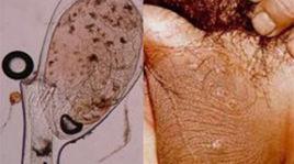 陰虱寄生病 陰虱寄生病