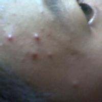 美國噻咪歐疤痕組合 美國噻咪歐疤痕組合