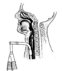 經口腔結核病灶清除術 經口腔結核病灶清除術