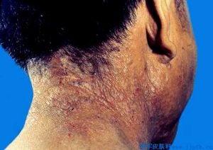 神經性皮炎示意圖