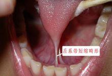 舌系帶矯正術適應症