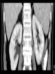 疼痛性脂肪瘤 疼痛性脂肪瘤